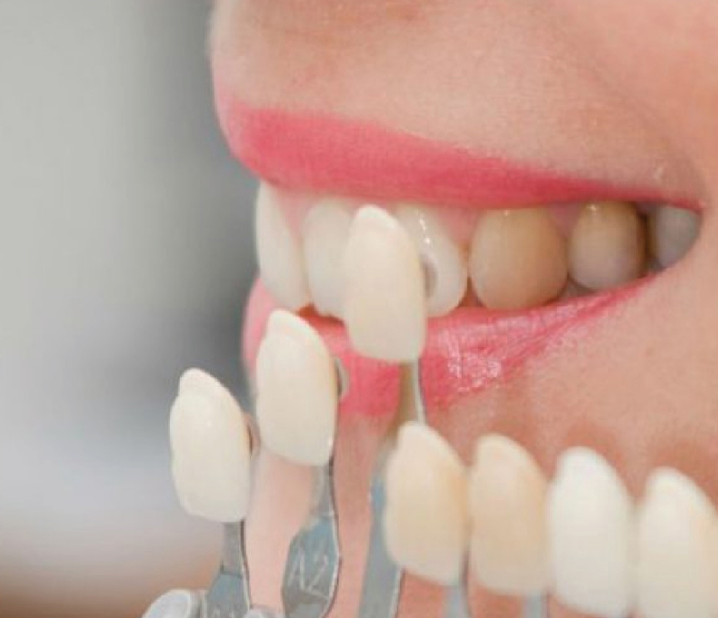 Carillas Dentales y Laminados Estéticos | DentalVital