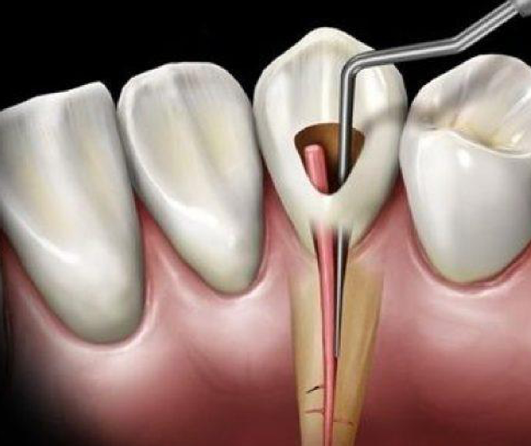 Tratamientos de Conducto (“nervio”) DentalVital