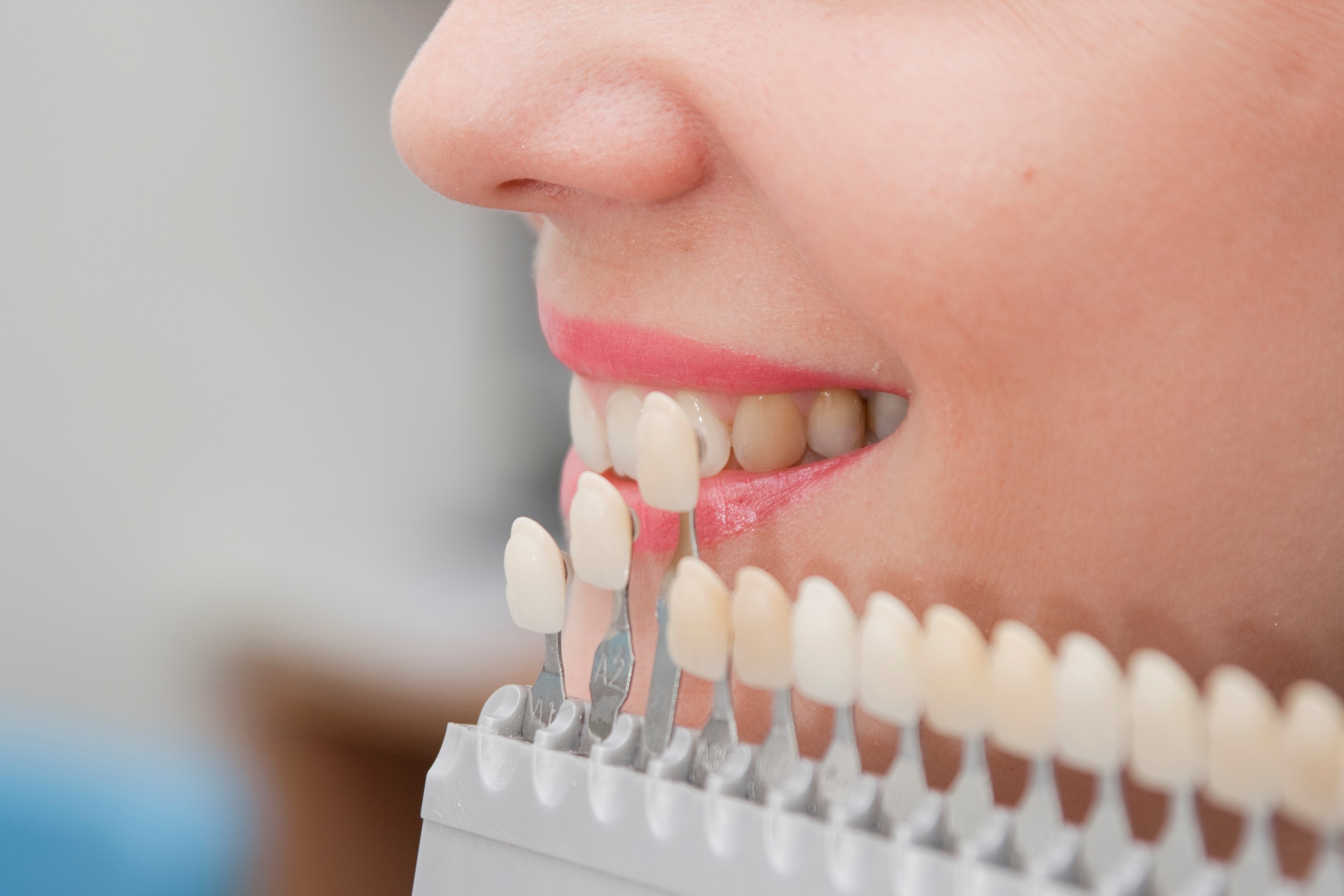 Sabe cómo se colocan las carillas dentales sin desgaste? - Estética dental