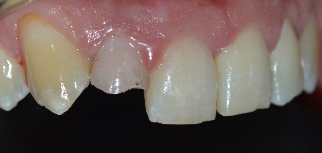 Fracturas Dentales Dentalvital